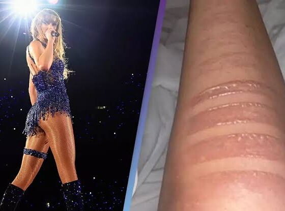 Taylor Swift rushed to the hospital for second degree burn from cooking for Travis Kelce...Full details