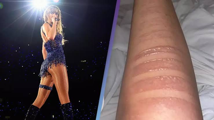 Taylor Swift rushed to the hospital for second degree burn from cooking for Travis Kelce...Full details